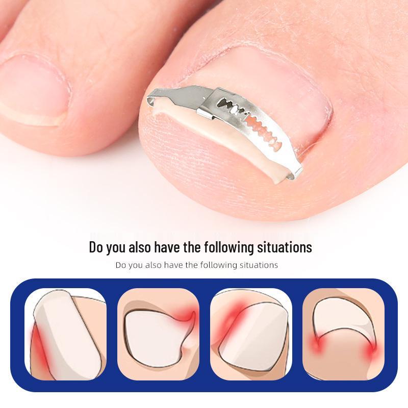 Ingrown Toenail Orthotic Patch & Foot Care Tool for Curled Nails and Nail Groove Ingrowth