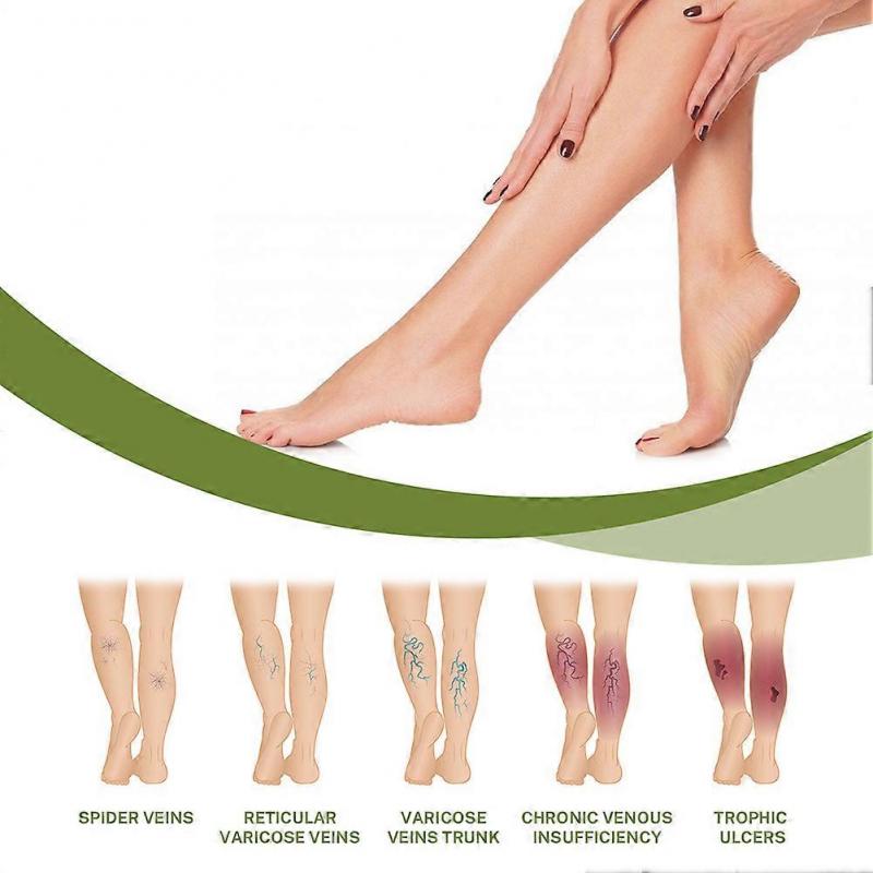 50g Varicose Veins Cream, Effective Varicose And Spider Veins Treatment