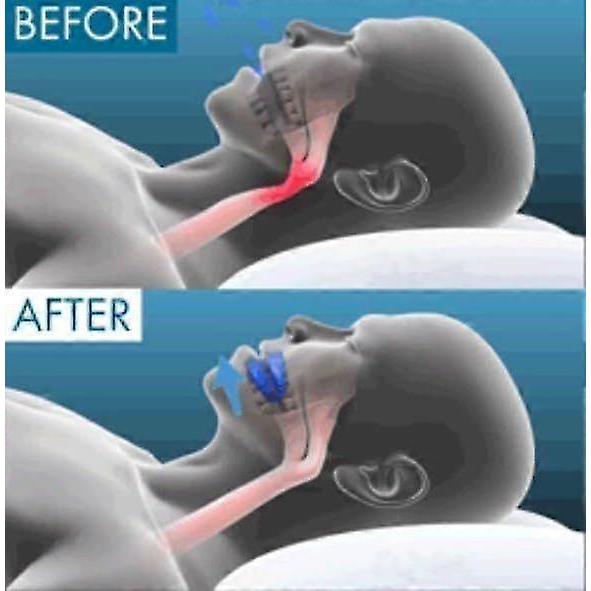 Universal Anti-Snoring Mouthpiece Quiet Sleep Aid Device Compatible with Honex 2025 Latest Model