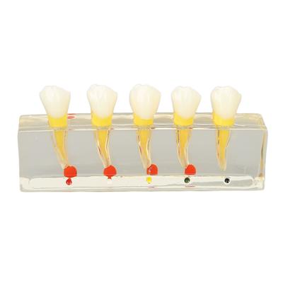 Teeth Model Dental Study Transparent Implant Dental Caries Model for Dental Teaching