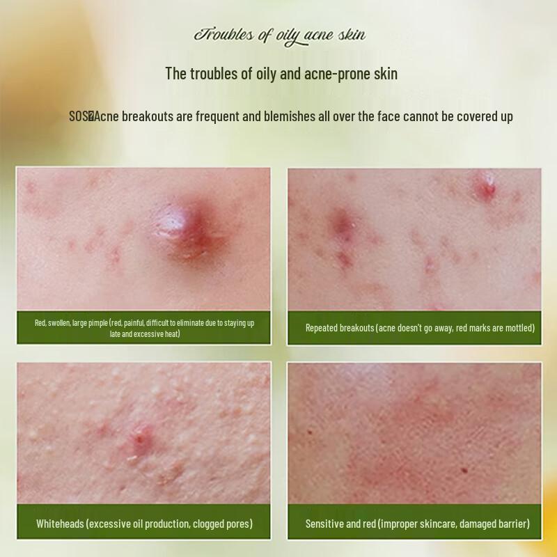 Jingxin Acne Treatment Cream