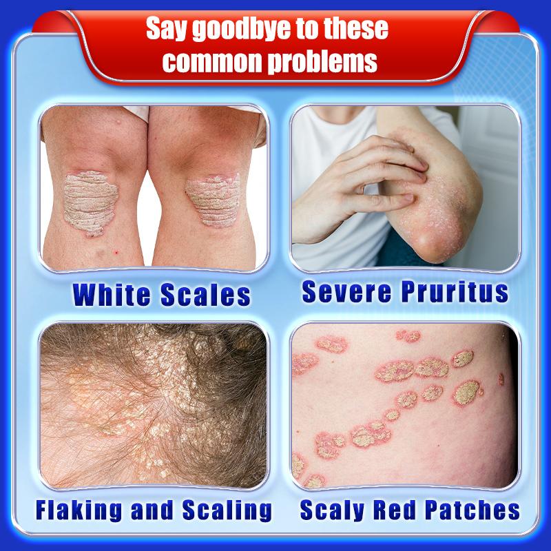 Cowhide Moss Care Cream To Relieve Hand and Foot Skin Itching Discomfort Moisturizing Skin Cool Care Cream