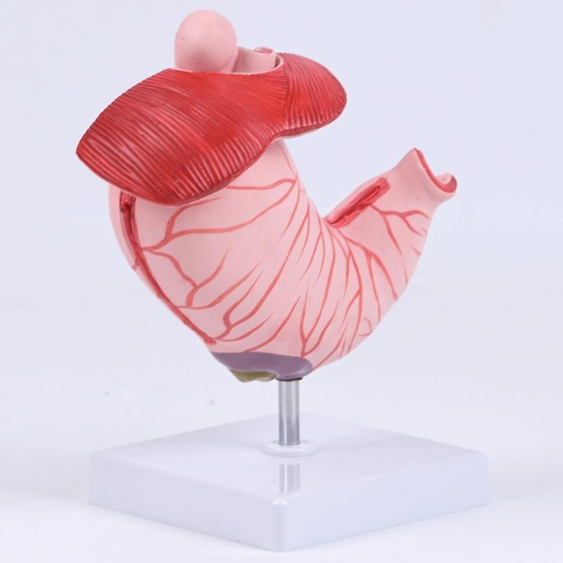 Diseased Stomach Model Stomach Anatomy Model Pathological Stomach Model For Medicals Students And Healthcare Learning
