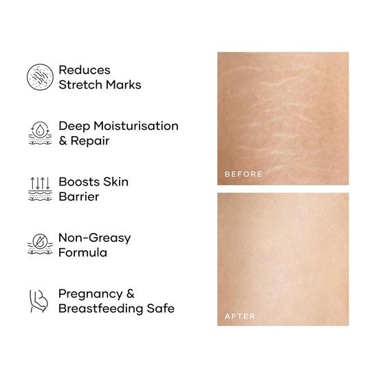 Cureskin Smoothing Body Butter Stretch Marks Cream for Women and Men | Stretch Marks Removal Cream for Women