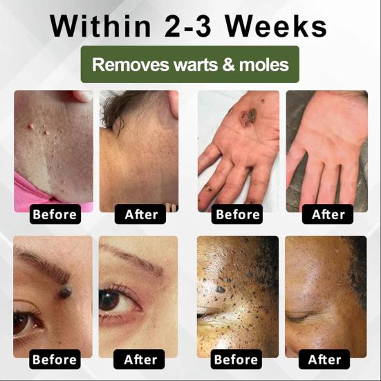 Instant Mole Spot Removal Gel Corrector Cream for All Skin Types Natural Extracts 50g Hydrating Gel Dark Spot Remover
