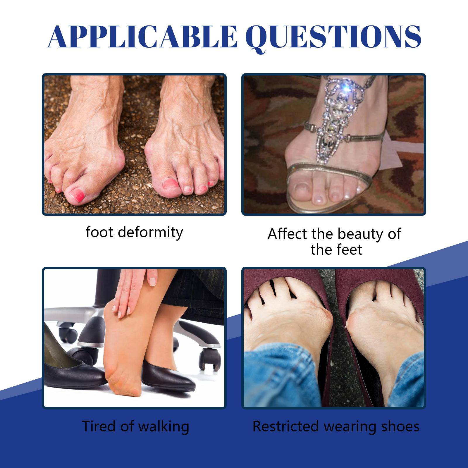 

Ximonth 30 шт., выпрямитель для пальцев ног, выпрямитель для суставов большого пальца, патчи для суставов большого пальца, дышащие, быстрого действия