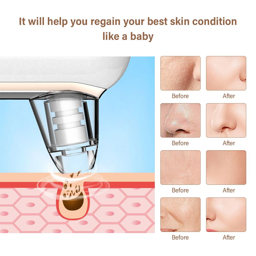 Blackhead Remover Vacuum USB Rechargeable Pore Cleaner-3 Suction Power, 4 Modes
