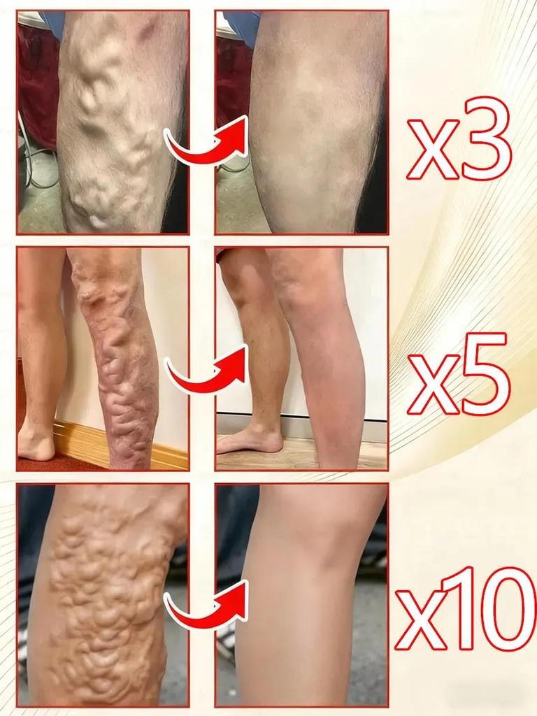Petzoshenk German Varicose Veins Leg Veins Bulge Dilated Red Blood Cold Compress Gel