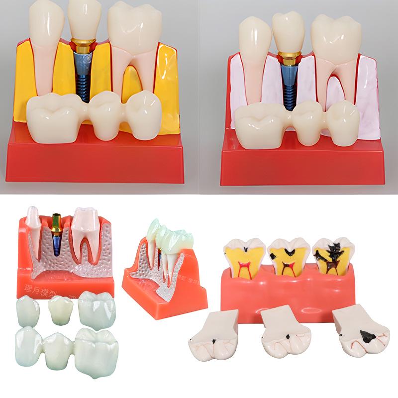 Dental Implant Teaching Model & Toothbrush Preparation Resin Mold