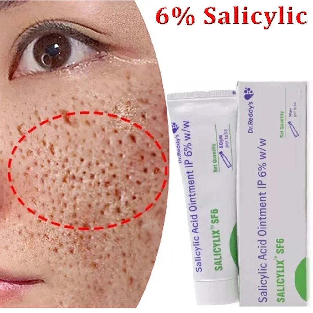 Salicylic Acid Acne Cream For Face Against Black Dots Acne Treatment & Open Pores Moisturizing Skin Care Cream - 50 g