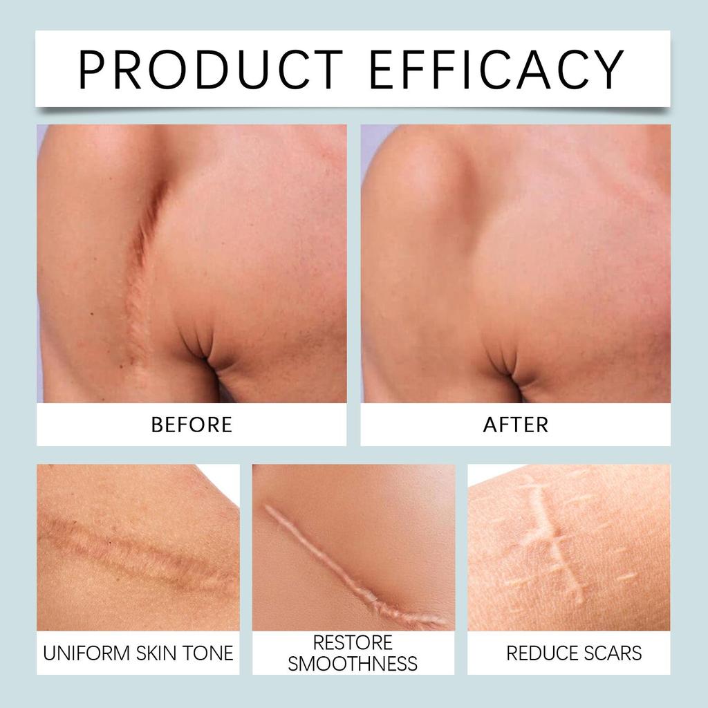 Laniska Silicone Scar Tape, 4cm×150cm, Soft & Breathable, for Scar Care & Skin Smoothing