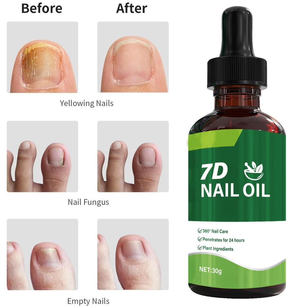 30ml Toenail Fungus , 7 Day Toenail Fungus , 7 Plant Extracts, Suitable For Athlete's Foot, Thick Nails, Broken Nails, Discolo