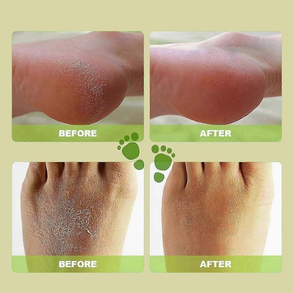 Ginger Foot Peel Spray, Foot Peel Callus Remover For Feet Spray, Foot Moisturiser Foot Care Spray, Foot Exfoliating Spray, Softener Foot Spray for Dea