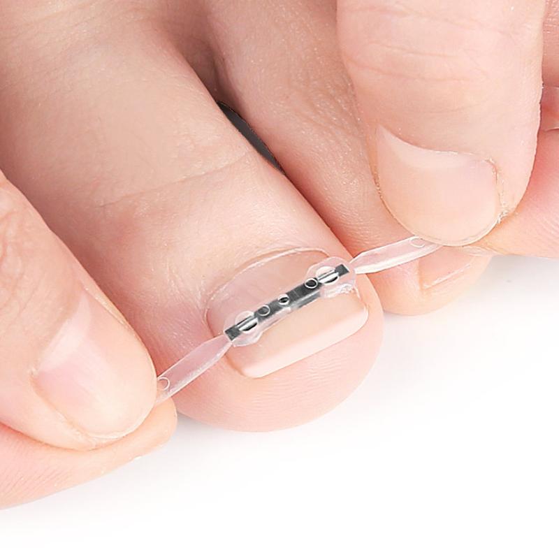 Ingrown Toenail Corrector Tools Pedicure Recover Embed Toe Nail Treatment Professional Ingrown Toenail Straightening Clip Brace