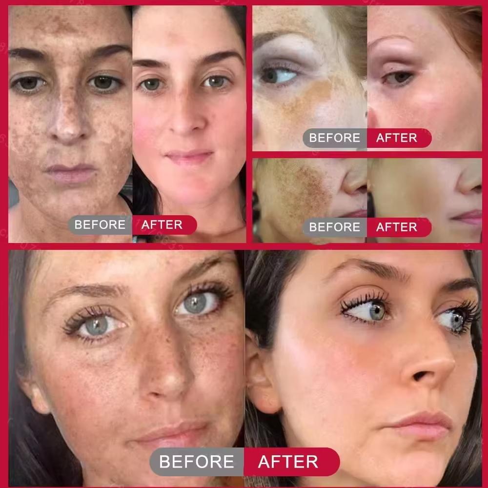 Powerful Spot-removing Whiten Cream Brighten Skin Fast Eliminates Melanin Pigmentation Melasma Dark Spots Moisturize Skin Care