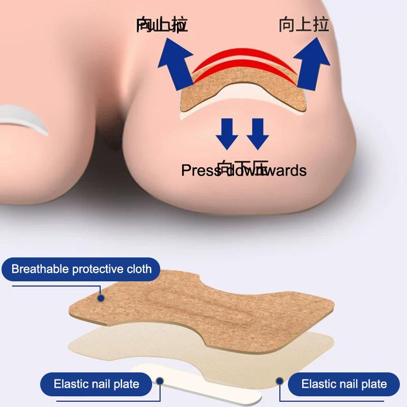 Ingrown Toenail Toe Correction Stickers Paronychia Treatment Recover Corrector Patches Feet Care Paronychia Treatment Recover