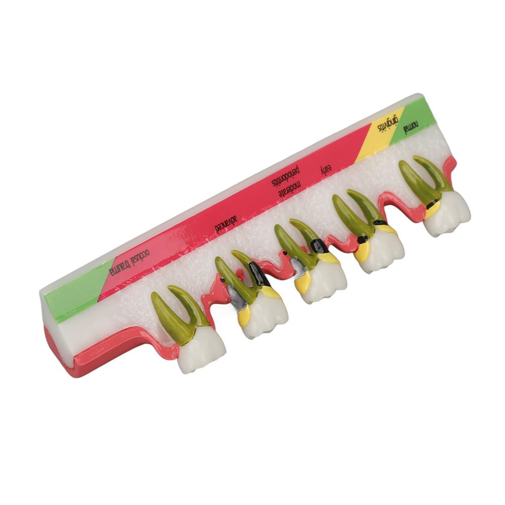 Teeth Periodontal Disease Model Different Stages Resin Dental Periodontitis Display Model