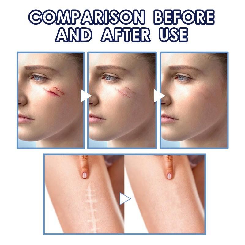 Eelhoe Scar Repair Cream For Reducing Scars And Smoothening Skin With 50ml Capacity