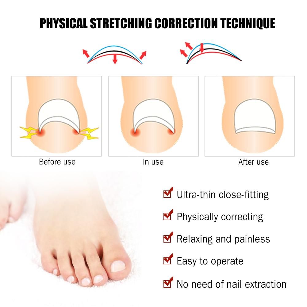 Buy Professional Ingrown Toe Nail Correction File Pedicure Toes Treatment Tools Care At Affordable Prices Free Shipping Real Reviews With Photos Joom