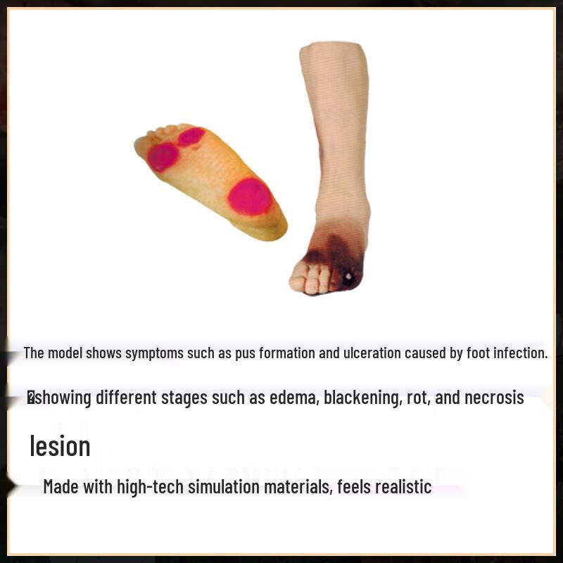 Diabetic Foot Ulcer Teaching Model