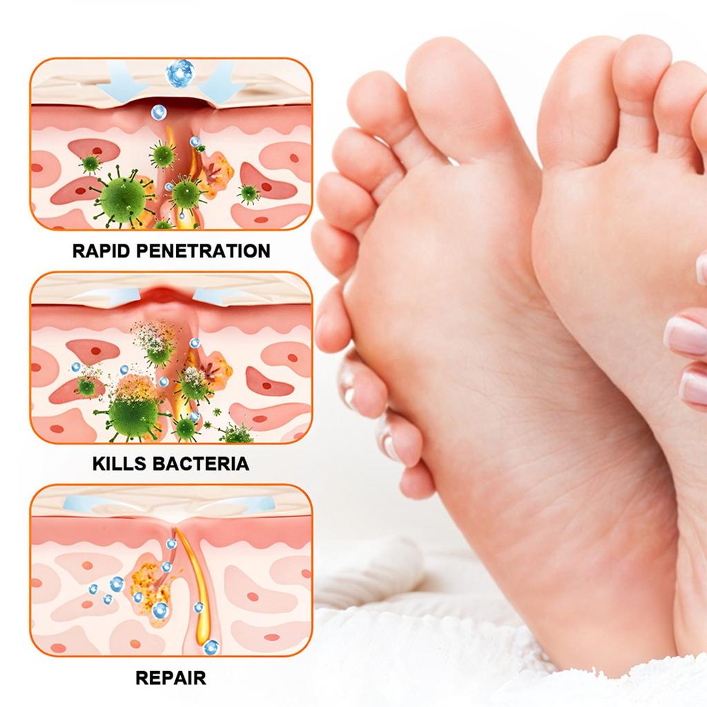 Bee Nagelwachstumsspray Nagelöl Mykosepflege Für Nagelmykose Fußmykose Rotbraun Fuß 60ml