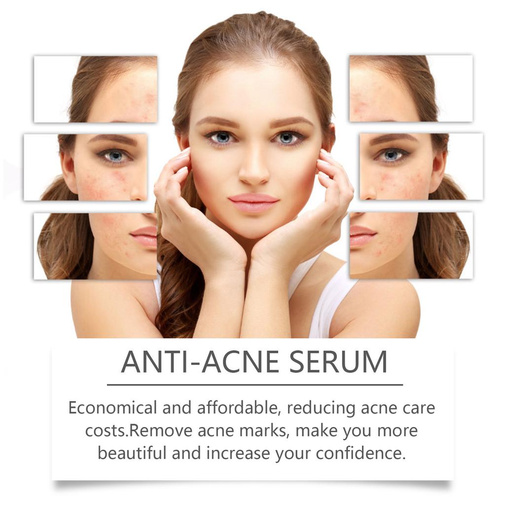 Niacinamide Anti-Acne Serum, Gentle Acne Treatment Serum for Face, Improve Blemishes & Moisturizing Repair Essence