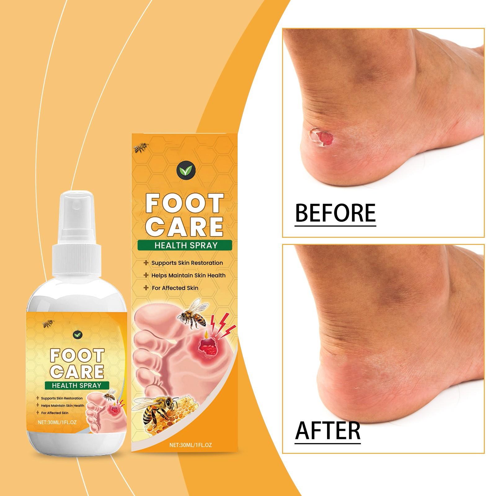 

30 мл спрей для лечения диабета, ран, отеков ног, зуда, боли One Size