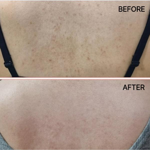 Merphil Back Acne / Body Acne Improvement AC+ Body Mist 200 mL & AC+ Magic Cleanser 500 g Set