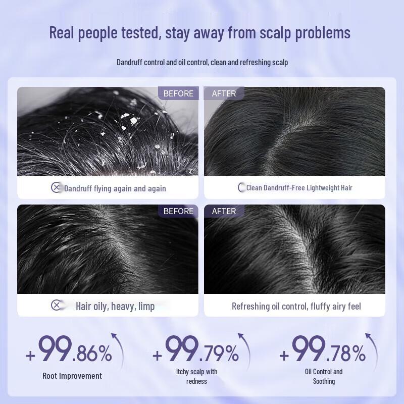 Selenium Disulfide Anti-Dandruff Shampoo & Dual Acid Shower Gel Set