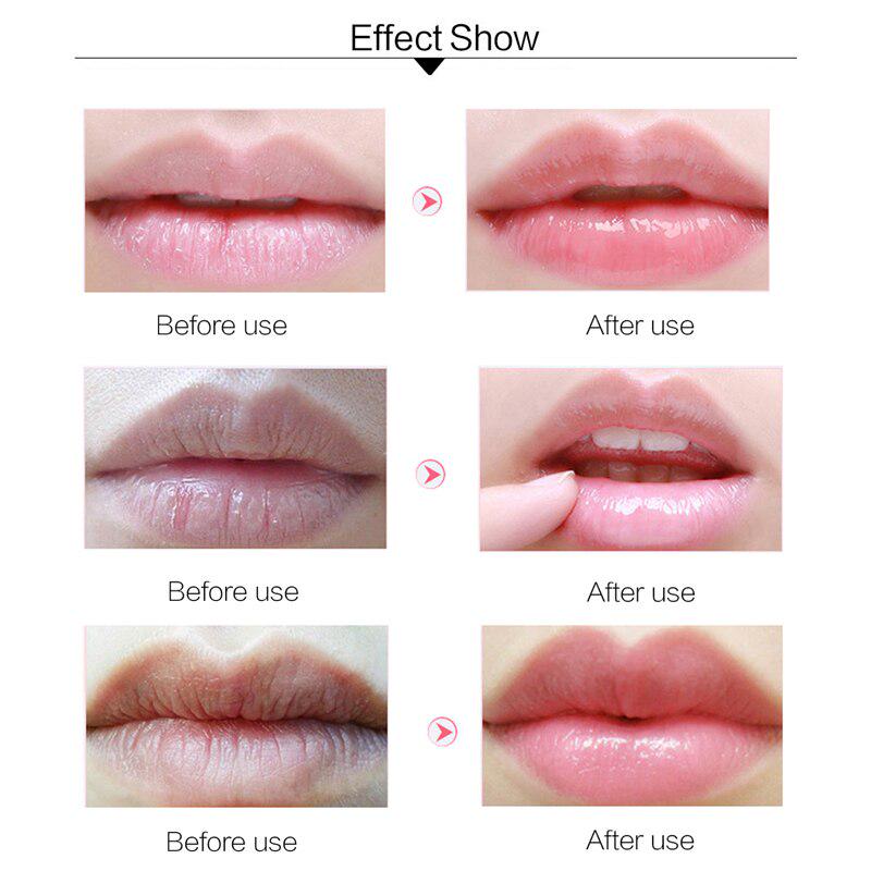 Can You Put Hyaluronic Acid On Lips