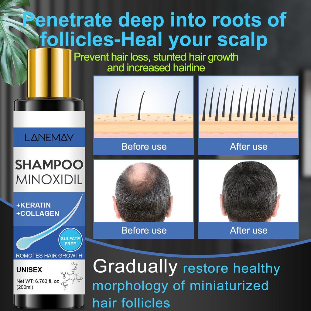 Minoxidil Shampoo-Reduce Hair Loss, Romotes Hair Growth-Stable Hair Volume And Healthy State-Suitable For All Hair Types, 200ml