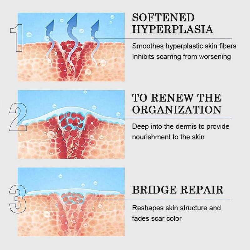 Fjerning av arr Hjelper mot gamle og nye arr for kirurgisk for ansikt og kropp