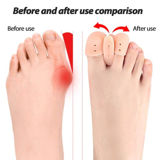 1 Pair 2-Hole Toe Separator Orthopedic Bunion Valgus Hammertoe Corrector
