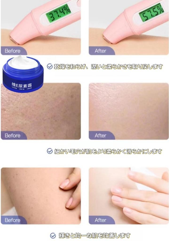 Spot Fading Urea Cream, 2 pcs, Japanese Urea Cream, Dark Spot Removal Urea Vitamin E Cream, Fruit Acid Urea Cream, Reduce Winkles, Even Skin Tone