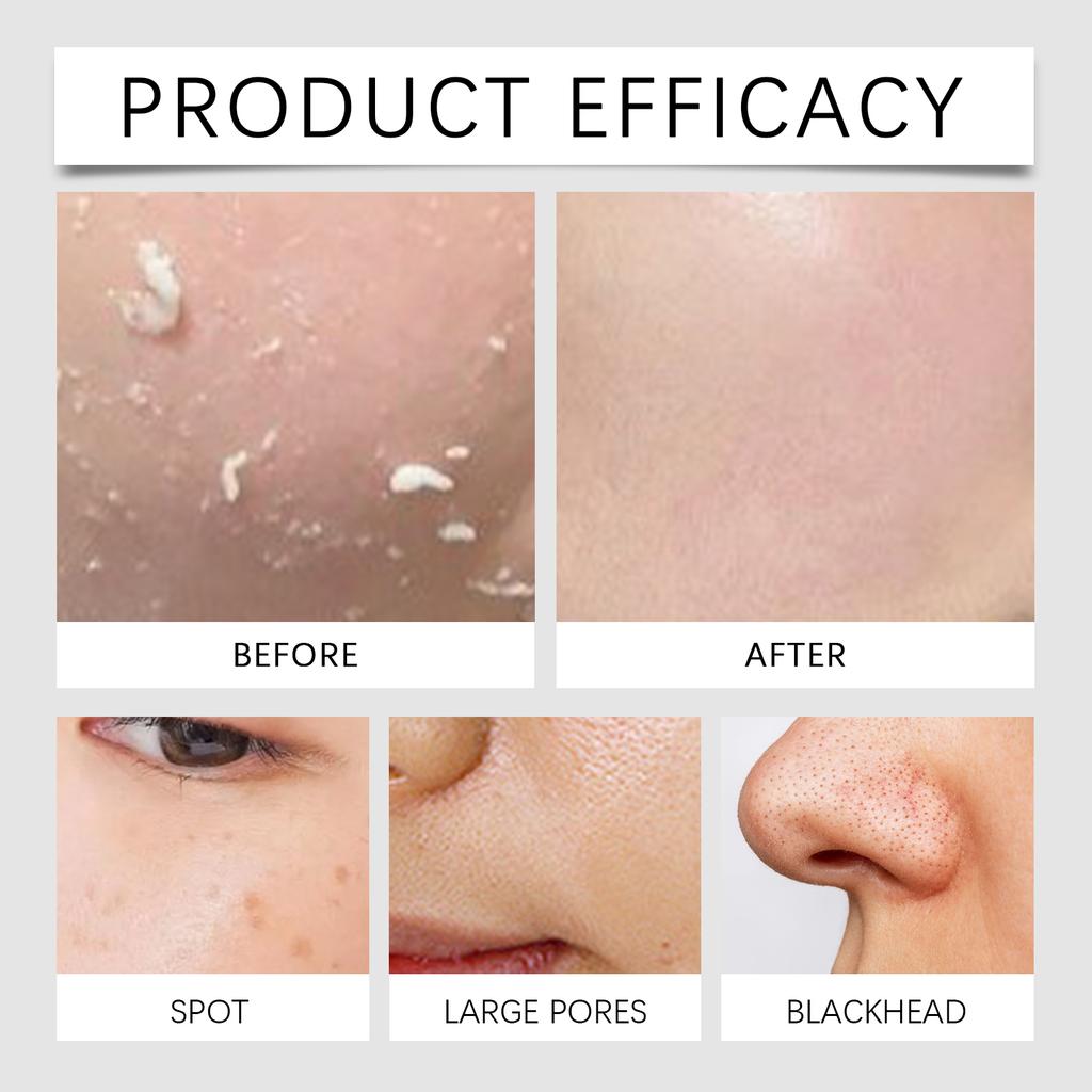 Salicylic Acid Exfoliating Toner 100ml Pore Minimizer Blemish Control Liquid Papaya Extract Hydrating Facial for Acne Prone Skin