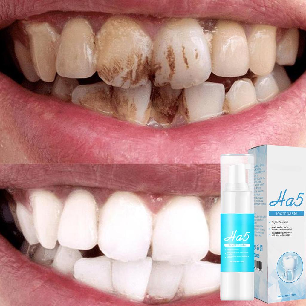 Le dentifrice à l'acide hyaluronique HA5 élimine efficacement les taches et les taches sur les dents.; Éclaircir les dents Renforce, protège et blanchit les dents sensibles