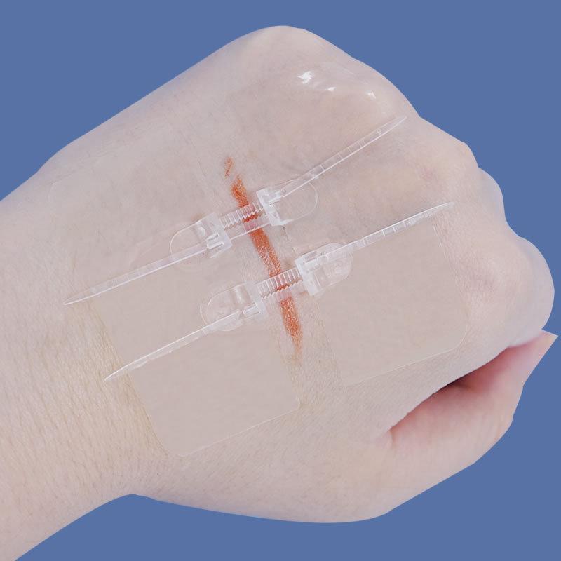Zipper-Type Tension Reducer: Suture-Free Medical Wound Closure Device