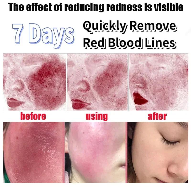 Crema Riparatrice Rossori Viso Lenitiva Pelle Sensibile Secchezza Idratante Lozione Idratante Rimozione Rosacea Cosmetici Coreani