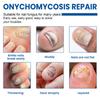 Onychomycosis Solution, Thickening Bright Onychomycosis Remover, Soft Onychomycosis, Hand And Foot Nail Care Solution 30ml