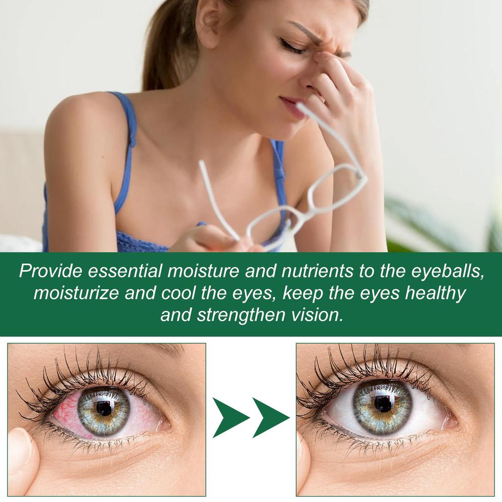 Ximonth Eye Drops Relieves Eye Fatigue Dryness Itching Watery Eyes Soreness And Blurred Vision Moisturizing Eye Care Solution