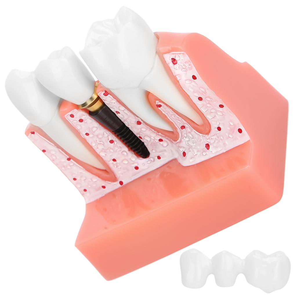 Model zubů Analýza zubního implantátu Demonstrační model korunkového můstku Model zubu
