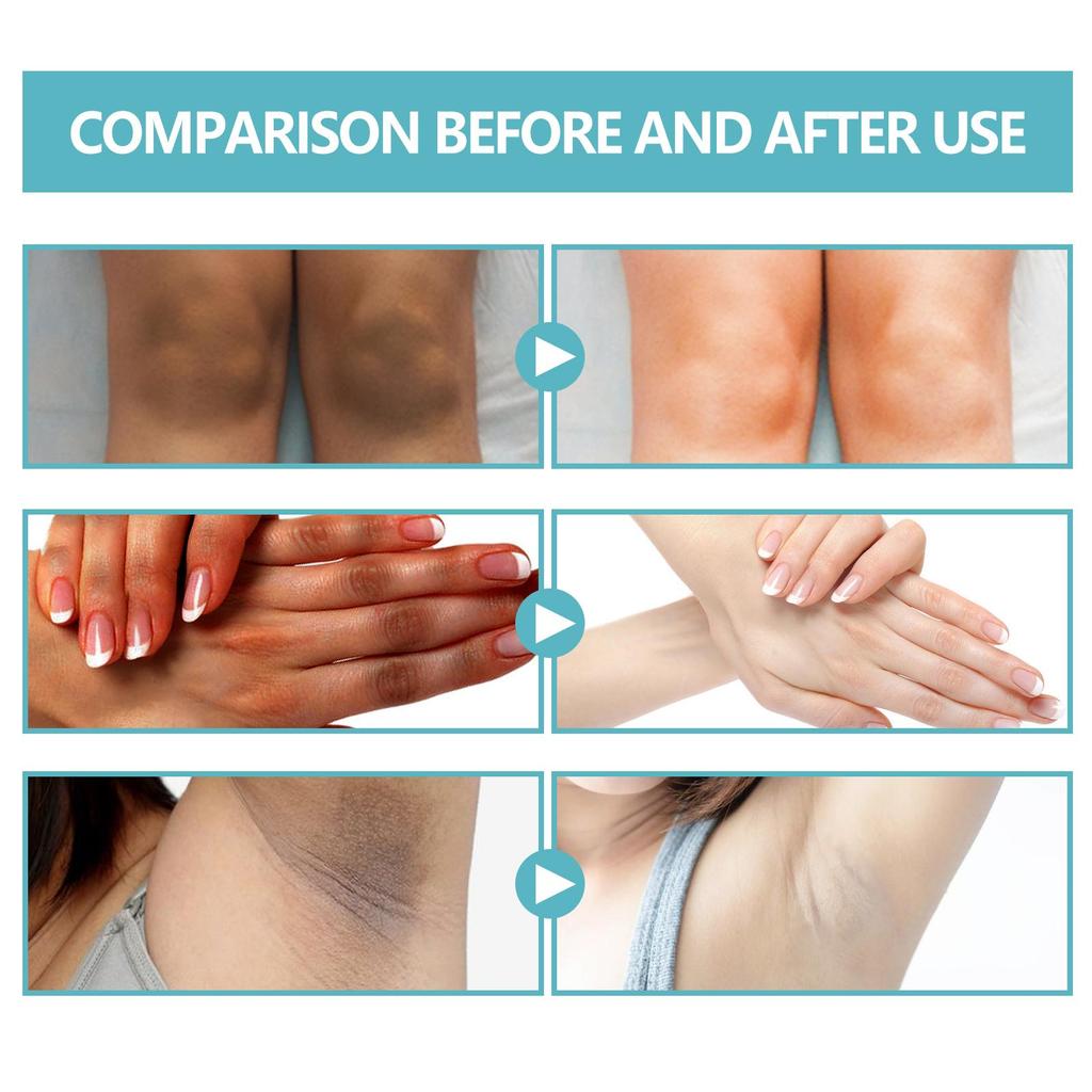 Spot Remover For Body,Spot Corrector Cream,- Underarm, Neck, Armpit, Knees, Elbows, Private Areas, Intimate Areas