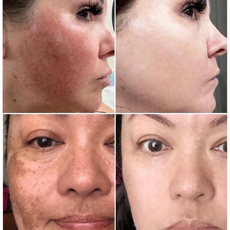 Crème blanchissante efficace pour les taches de rousseur, élimine le mélasma, atténue les taches brunes, hydrate, éclaircit la peau du visage, produit de soin