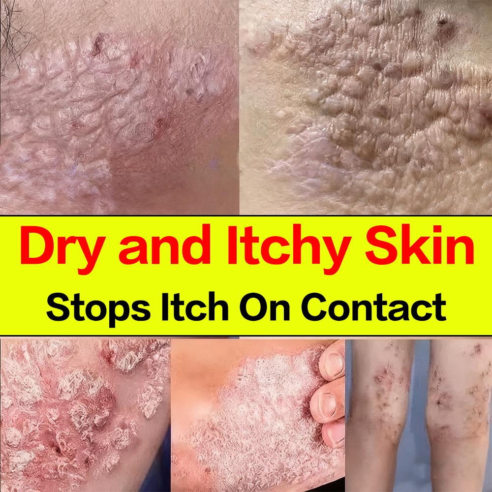 Therapeutic Cream Dedicated To Eczema Care