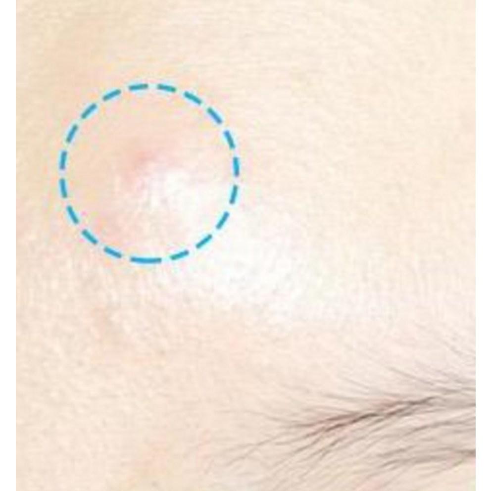 [Heseulin] Spot Care Patch Kit, 76 Patches, 2 Packs