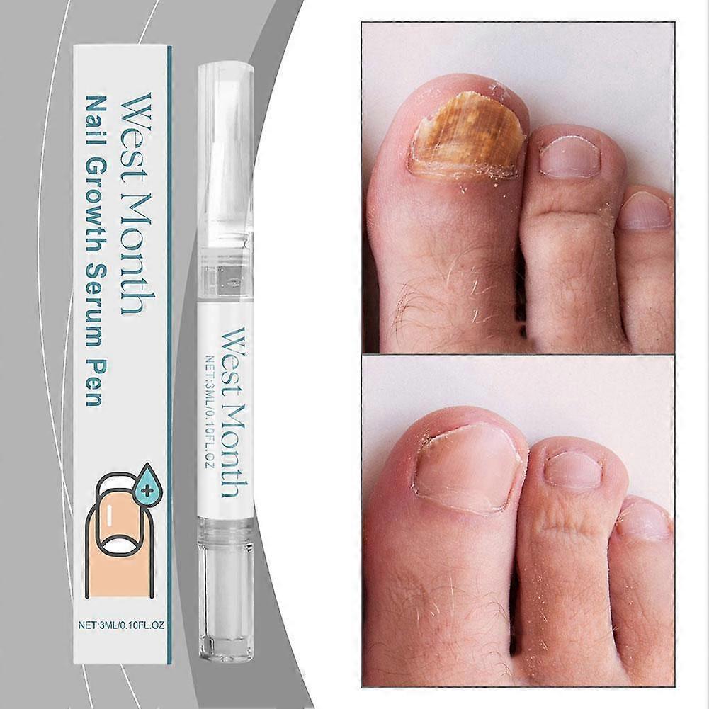 Penna Siero per la Crescita delle Unghie - Siero per la Cura delle Unghie Promuove la Crescita delle Unghie 3ml