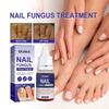 Ouhoe Nail Repair Solution Thickening Treatment For Ingrown Nails And Fungal Issues
