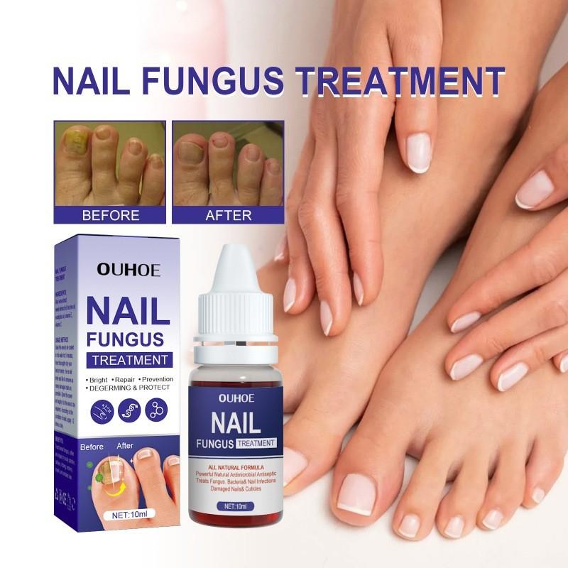 Ouhoe Nail Repair Solution Thickening Treatment For Ingrown Nails And Fungal Issues