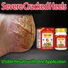 Powerful Chapped Hand and Foot Cream, a Touch of Pain Relief, Quick Healing