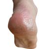 Foot Callus Removal Patch, Cracked Heels, Calluses, Exfoliation, 30 Sheets